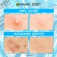 Garnier Micellar Cleansing Water Salicylic Acid BHA For Dull & Acne Prone Skin 125ML
